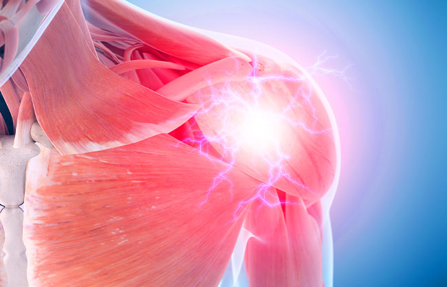 Adhesive Capsulitis in Capitola, California