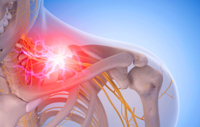 Patient undergoing Brachial Plexus Neuritis treatment at Harbor Health Center