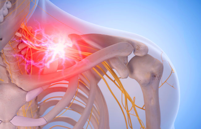 Brachial Plexus Neuritis in Capitola, California