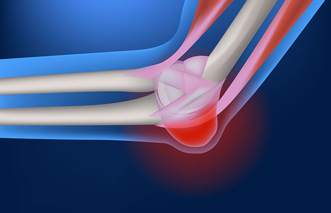 Bursitis in Capitola, California