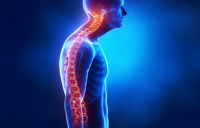 Kyphosis in Capitola, California