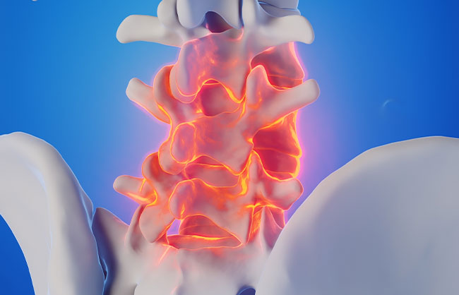 low back pain in Capitola, California