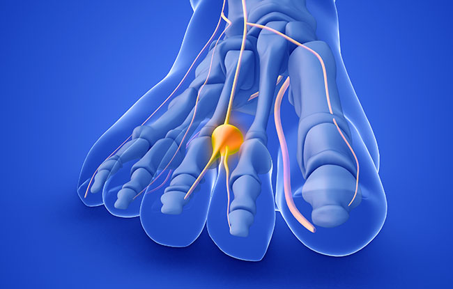 Patient undergoing Morton’s Neuroma treatment at Harbor Health Center