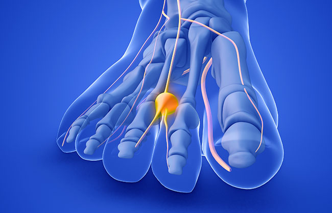 Morton’s Neuroma in Capitola, California