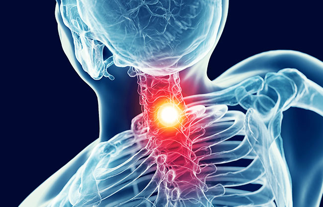 Neck Pain in Capitola, California