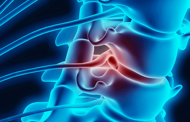 nerve impingement in Capitola, California