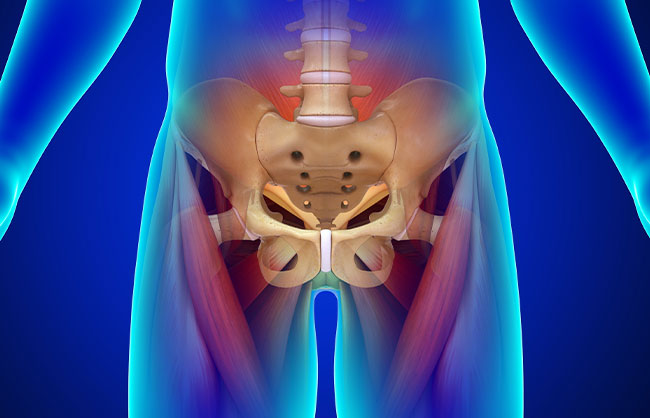 Piriformis Syndrome in Capitola, California