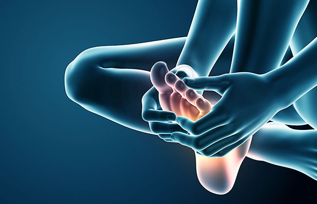 Plantar Fasciitis in Capitola, California