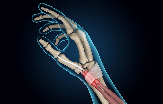 Tendonitis Capitola | Get Tendonitis Relief!