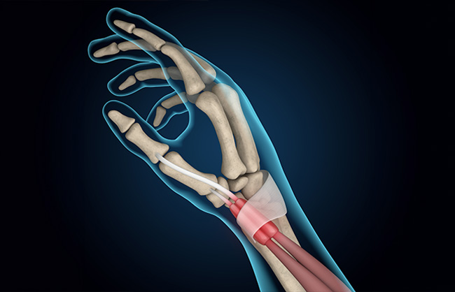 Tendonitis in Capitola, California